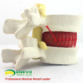 VERTEBRA08 (12392) Medical Science Demo model of lumbar disc herniation ,1.5 times, Pathological model for Patient Communication